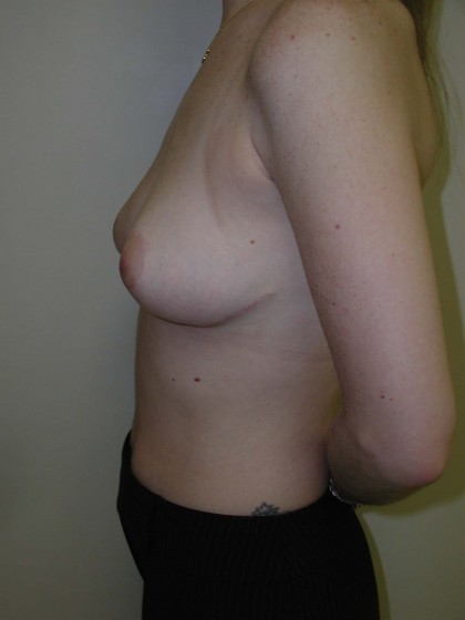 Breast Reduction Before & After Patient #269