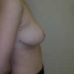 Breast Reduction Before & After Patient #269