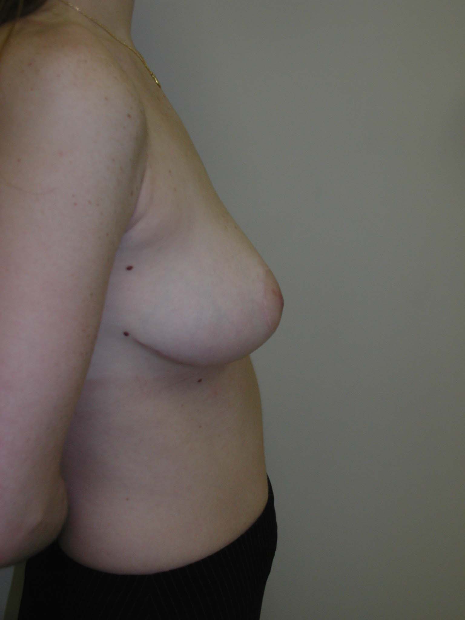 Breast Reduction Before & After Patient #269