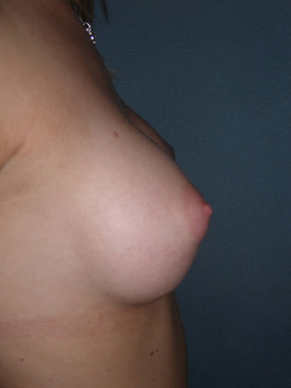 Breast Augmentation Before & After Patient #132
