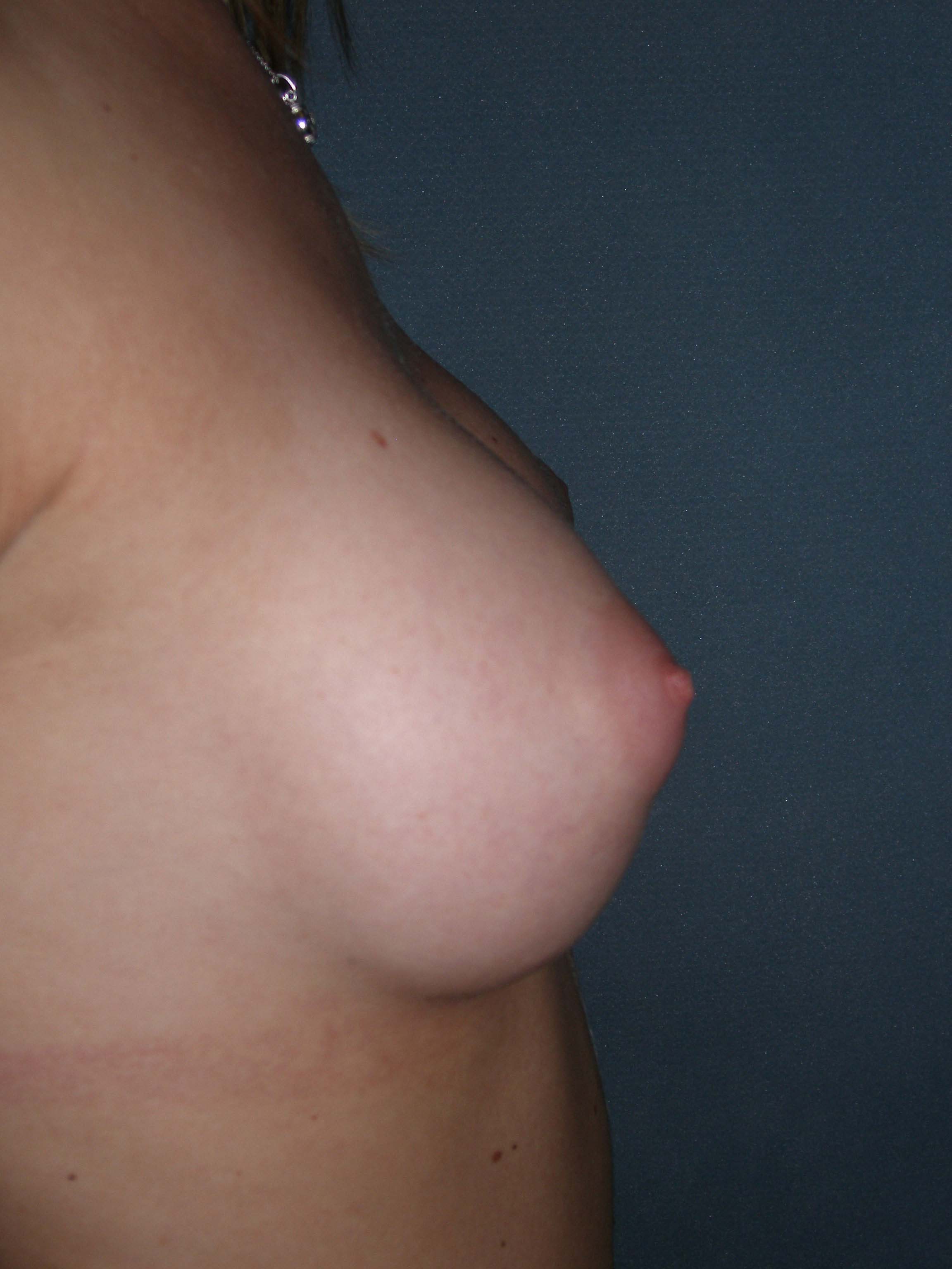 Breast Augmentation Before & After Patient #132