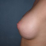 Breast Augmentation Before & After Patient #132