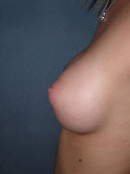 Breast Augmentation Before & After Patient #132