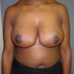 Breast Reduction Before & After Patient #277
