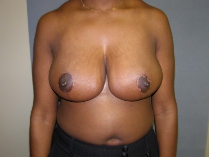 Breast Reduction Before & After Patient #277