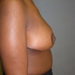 Breast Reduction Before & After Patient #277