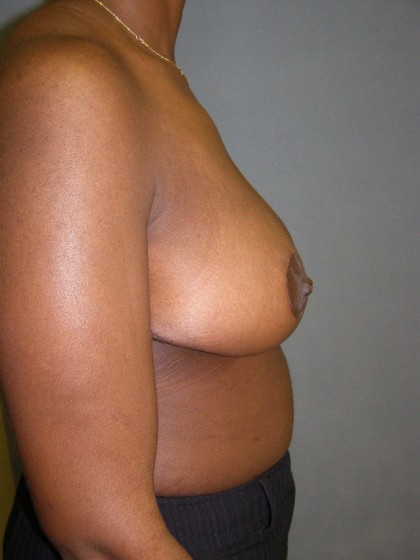 Breast Reduction Before & After Patient #277