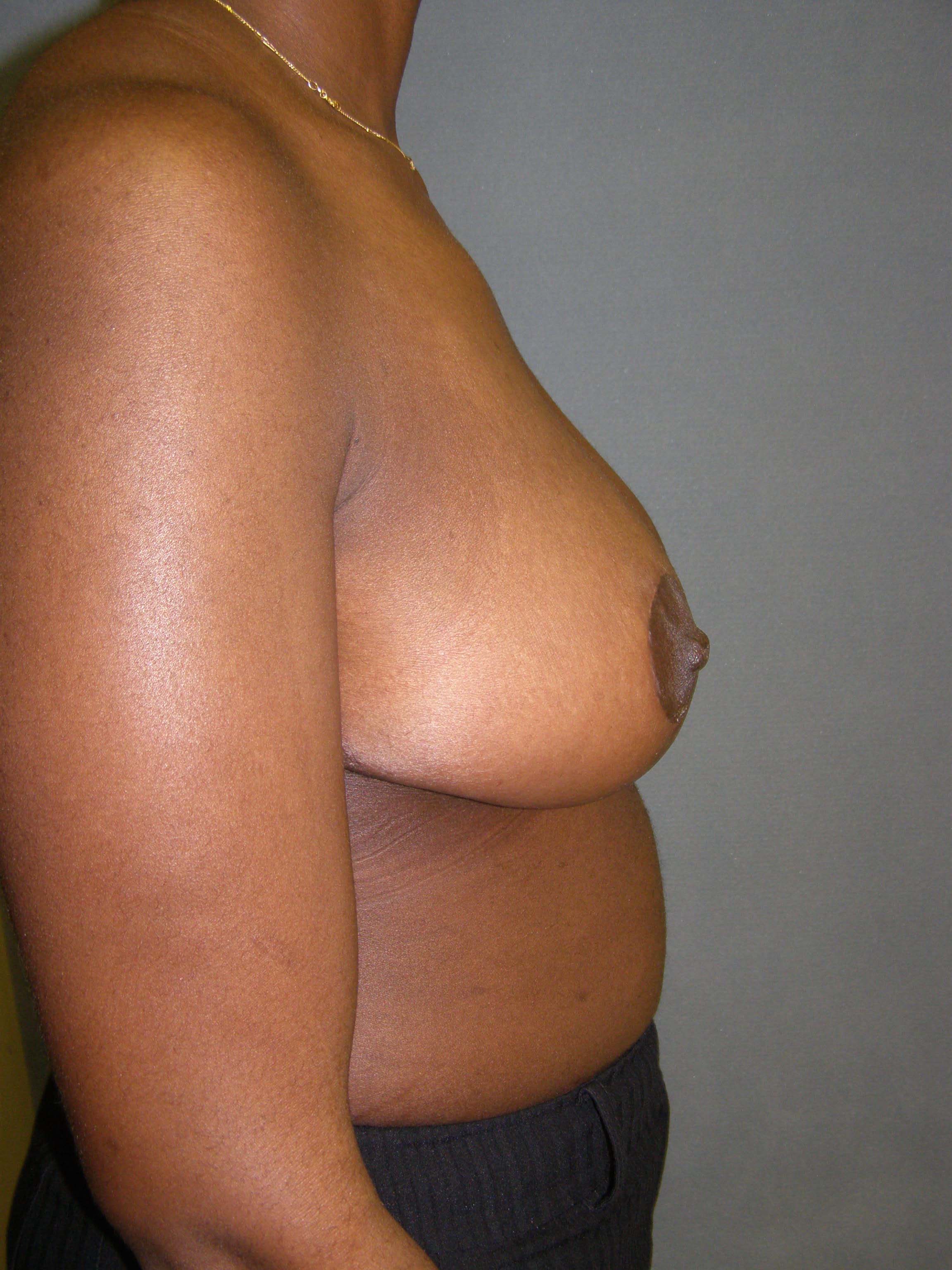Breast Reduction Before & After Patient #277