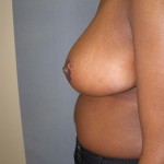 Breast Reduction Before & After Patient #277