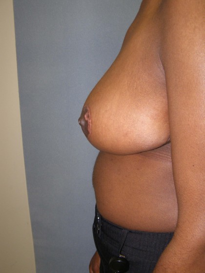 Breast Reduction Before & After Patient #277