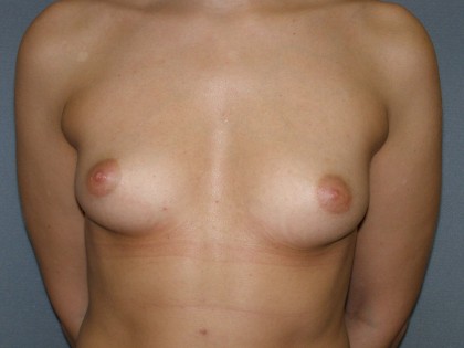 Breast Augmentation Before & After Patient #140