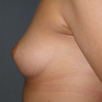 Breast Augmentation Before & After Patient #140