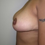 Breast Reduction Before & After Patient #285