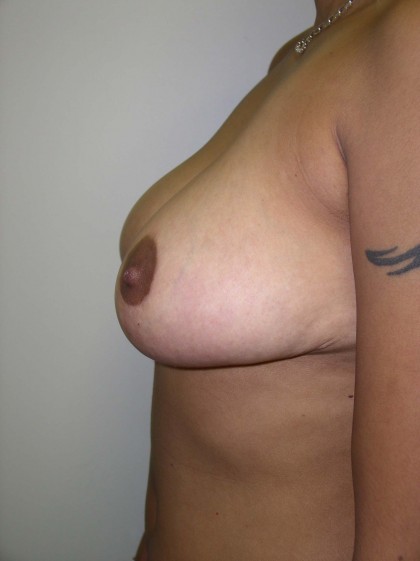 Breast Reduction Before & After Patient #285