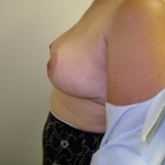 Breast Reduction Before & After Patient #292