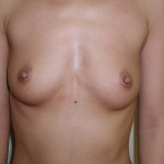 Breast Augmentation Before & After Patient #145