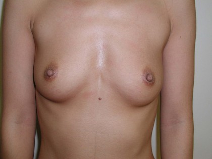 Breast Augmentation Before & After Patient #145
