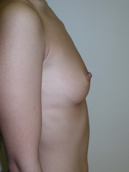 Breast Augmentation Before & After Patient #145