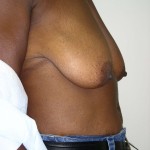 Breast Reduction Before & After Patient #297