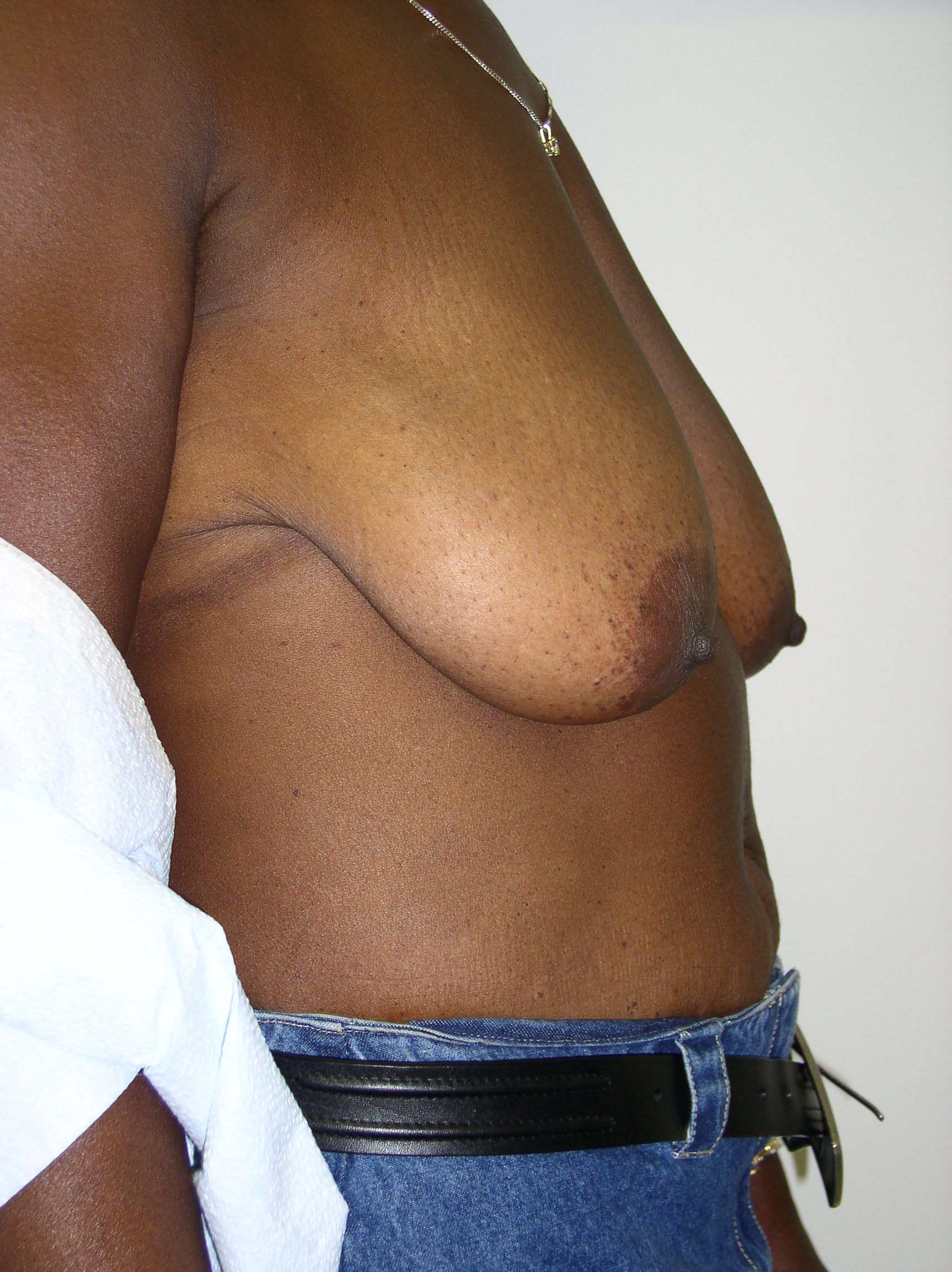 Breast Reduction Before & After Patient #297