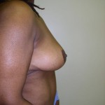 Breast Reduction Before & After Patient #297