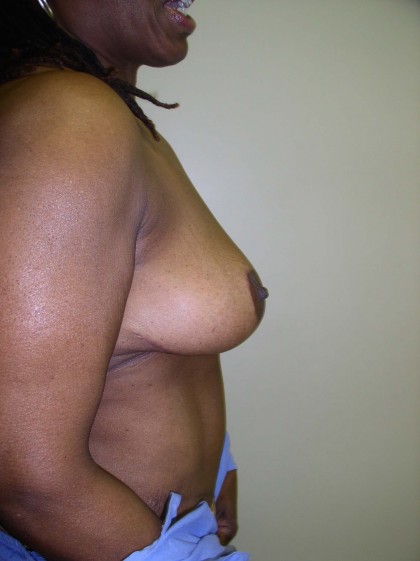Breast Reduction Before & After Patient #297