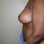 Breast Reduction Before & After Patient #297