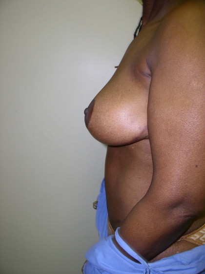 Breast Reduction Before & After Patient #297