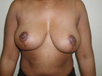 Breast Reduction Before & After Patient #305