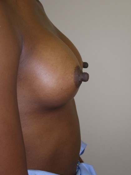 Breast Augmentation Before & After Patient #152