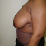 Breast Reduction Before & After Patient #308