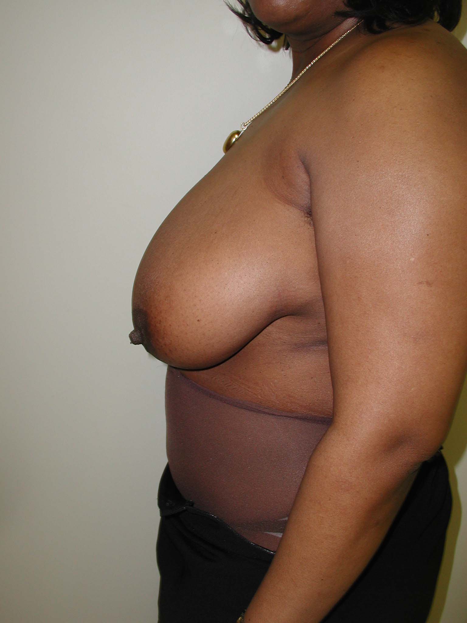 Breast Reduction Before & After Patient #308