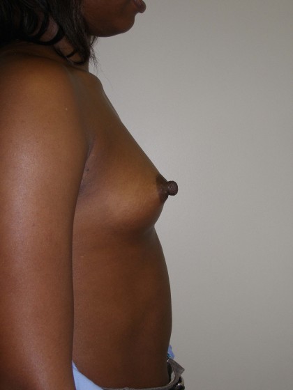 Breast Augmentation Before & After Patient #152