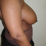Breast Reduction Before & After Patient #308