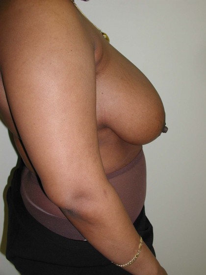 Breast Reduction Before & After Patient #308