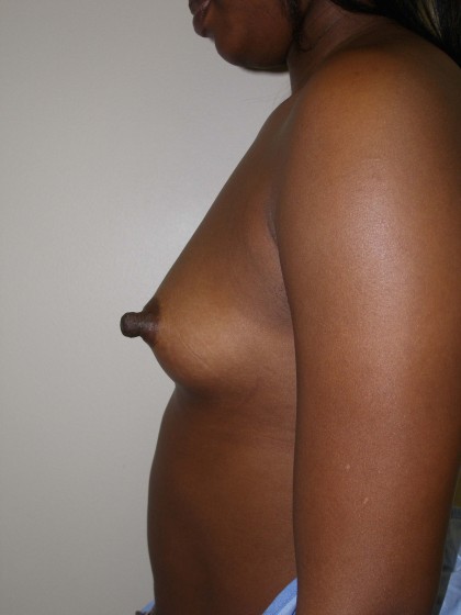 Breast Augmentation Before & After Patient #152