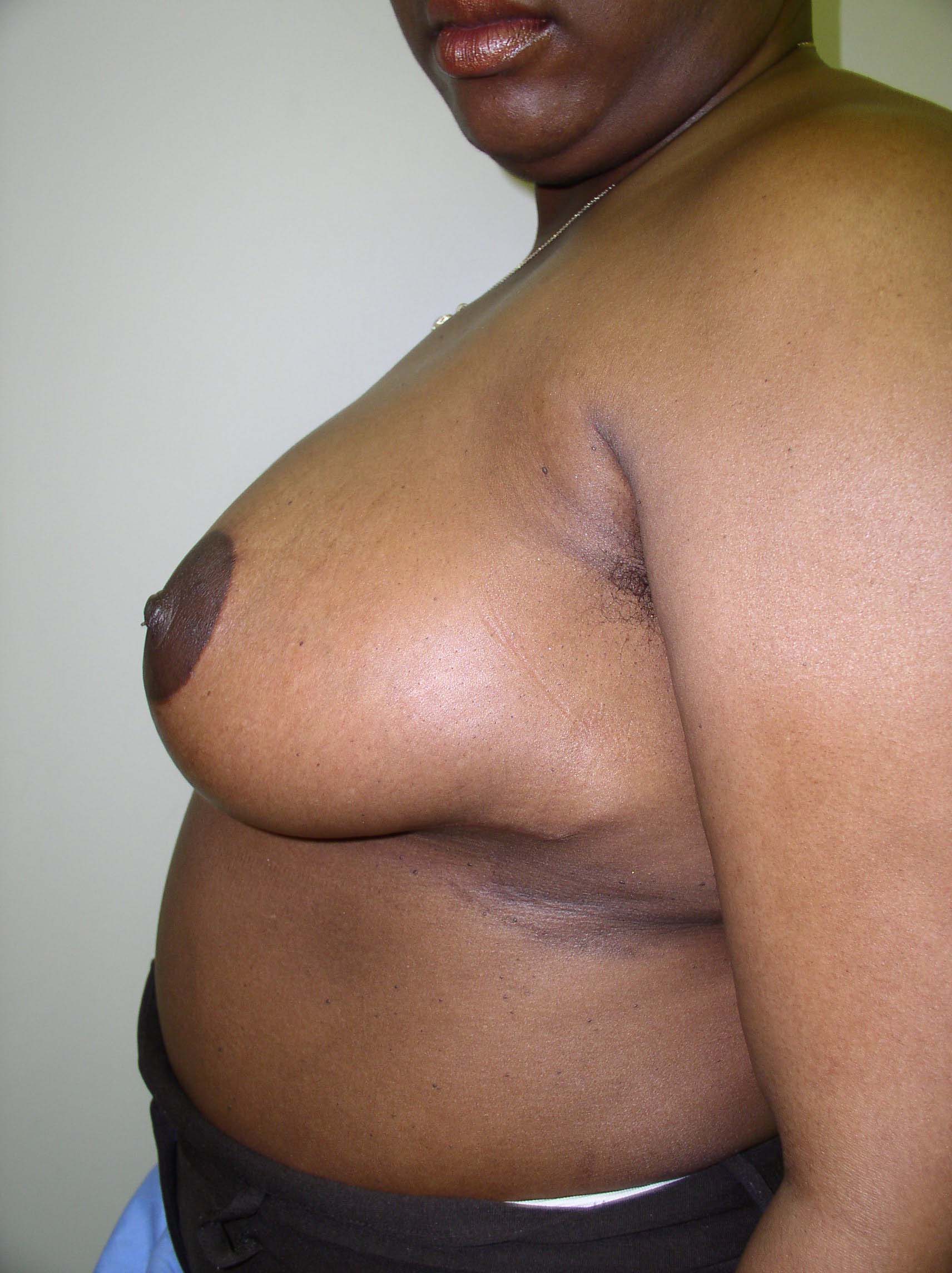 Breast Reduction Before & After Patient #308