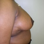 Breast Reduction Before & After Patient #308