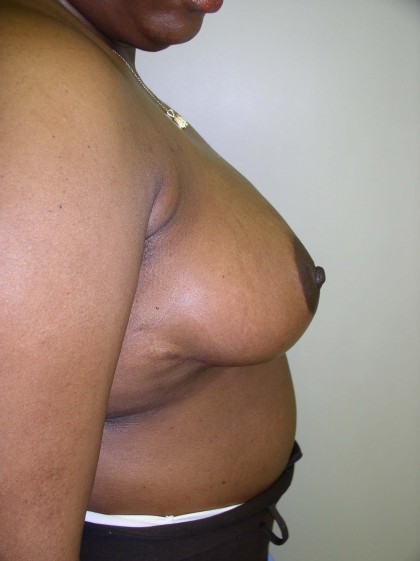 Breast Reduction Before & After Patient #308