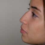Rhinoplasty Before & After Patient #4128