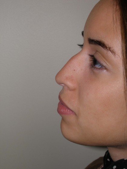 Rhinoplasty Before & After Patient #4128