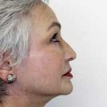 Facelift Before & After Patient #4377
