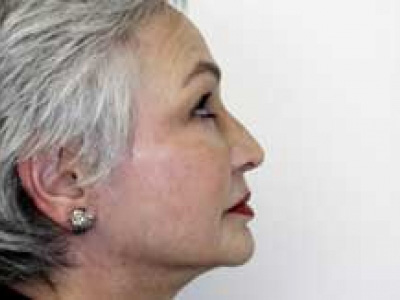 Facelift Before & After Patient #4377