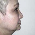 Facelift Before & After Patient #4377