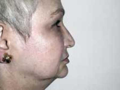 Facelift Before & After Patient #4377