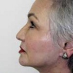 Facelift Before & After Patient #4377