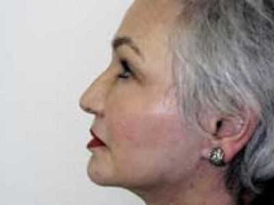 Facelift Before & After Patient #4377