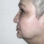 Facelift Before & After Patient #4377