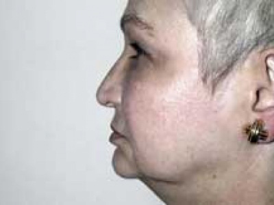 Facelift Before & After Patient #4377