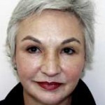 Facelift Before & After Patient #4377